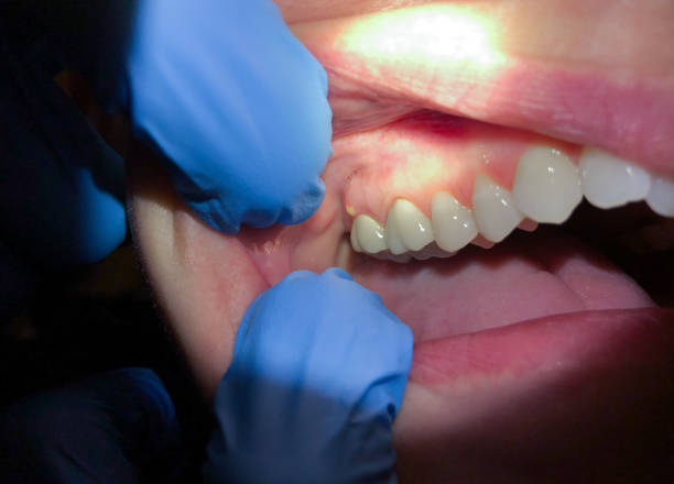 Best Emergency Dental Care for Sports Injuries in Greentown, IN
